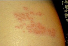What rash is this?