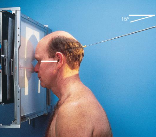<ul><li><p>patient position:</p><ul><li><p>upright (seated) or prone</p></li><li><p>MSP centered to midline</p></li><li><p>forehead and nose resting on Bucky/table</p></li></ul></li><li><p>part position:</p><ul><li><p>OML perpendicular to IR</p></li><li><p>MSP perpendicular to IR</p></li><li><p>IR centered to nasion</p></li></ul></li><li><p>respiration suspended</p></li><li><p>CR:</p><ul><li><p>15 degrees caudad, exiting nasion</p></li></ul></li><li><p>collimation:</p><ul><li><p>1 inch betond the lateral sides of the face, superiorly to include the supraorbital margins, and inferiorly to the chin</p></li></ul></li></ul><p></p>