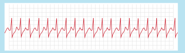 <p>The Registered Nurse is caring for a patient and notes the following rhythm on the cardiac monitor. The nurse correctly identifies this rhythm as:</p><p></p>