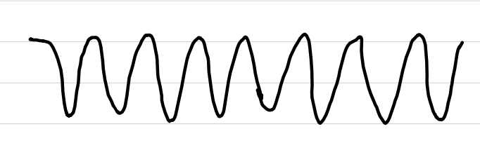 <ul><li><p>rate: <span style="color: red;">140-300 bpm</span></p></li><li><p>rhythm: regular</p></li><li><p>P waves: <span style="color: red;">not seen</span></p></li><li><p>PR interval: <span style="color: red;">not measurable</span></p></li><li><p>QRS complexes: <span style="color: red;">abnormal, >0.10 sec</span></p></li><li><p>ST segments: <span style="color: red;">not seen</span></p></li><li><p>subtype: Torsades de Pointe (party streamer shaped)</p></li></ul><p></p>