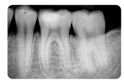 <ul><li><p>La periodontitis apical aguda también puede ser clasificada como: periodontitis apical aguda primaria: puede aparecer radiográficamente normal o con un ligero engrosamiento del espacio del ligamento periodontal</p></li><li><p>periodontitis apical aguda secundaria: puede tener una radiolucidez que rodea el ápice y pérdida de la lámina dura</p></li></ul><p></p>