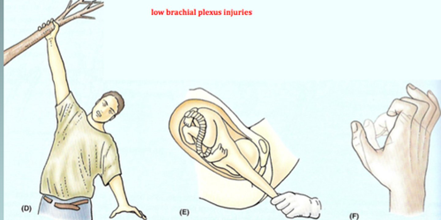 <p><strong>"klumpke's palsy"</strong></p><p>-lower brachial plexus injury (inferior trunk) </p><p>-claw hand </p><p>-arm raises too much over body, unable to extend </p><p>-C8, T1 </p>