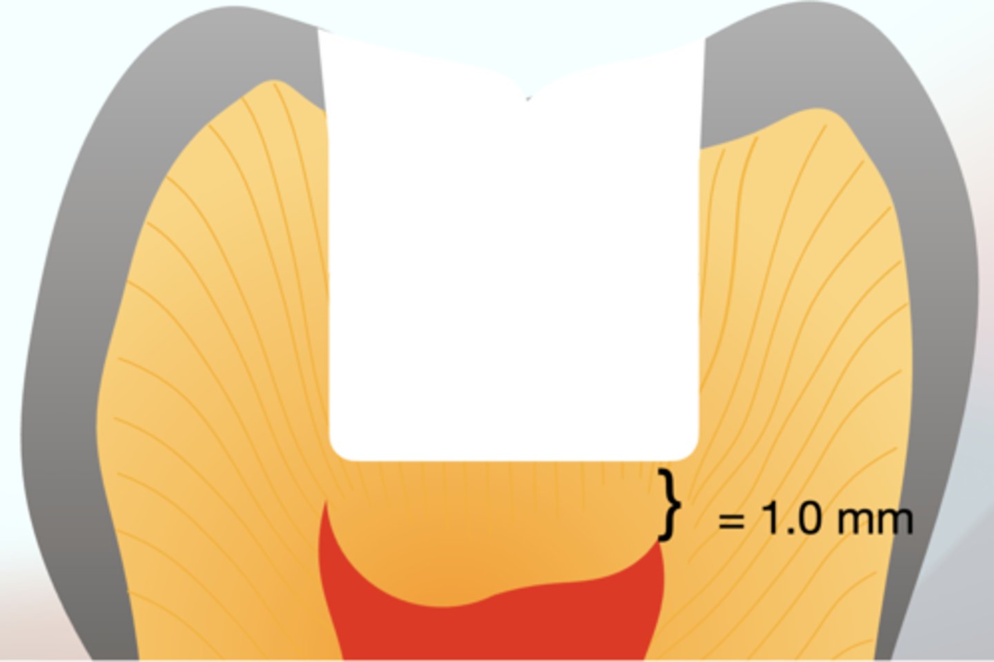 <p>1 mm of dentin</p>
