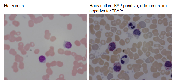 <ul><li><p><u><span>hairy cells</span></u><span>: in peripheral blood of >90% of patients</span></p><ul><li><p><span>represent <50% of leukocyte differential count</span></p></li><li><p><span>Scant to abundant, agranular, light grayish-blue cytoplasm with hair-like or ruffled projections</span></p></li></ul></li><li><p><u><span>Pancytopenia</span></u><span>: Granulocytopenia and monocytopenia; normochromic, normocytic anemia</span></p></li><li><p><u><span>BM</span></u><span>: dry tap due to fibrosis; increased reticulin (fibrosis</span></p></li><li><p><u><span>Cytochemistry</span></u><span>: TRAP staining (characteristic but not diagnostic) in hairy cells but negative in most other lymphocytes</span></p></li></ul><p></p>