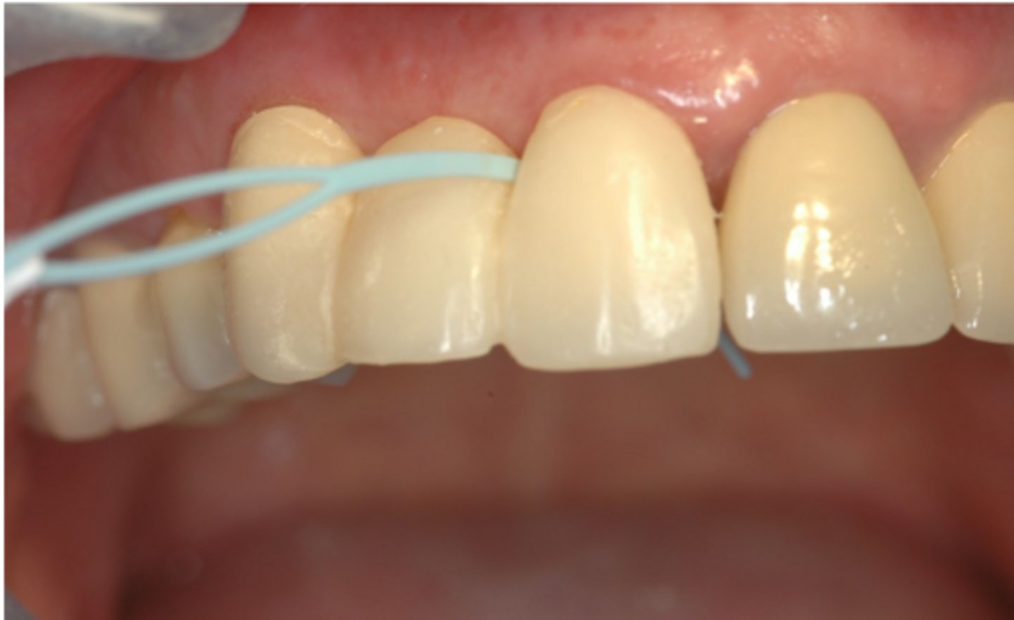 <p>What principle of provisional restorations states that the crown should permit patient to keep restoration and its surrounding tissue clean?</p>