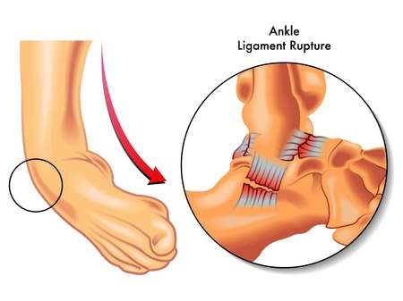 <ul><li><p>when LIGAMENTS are stretched or teared</p></li><li><p>commonly in areas like ankle, knees, and wrist </p></li></ul><p></p>