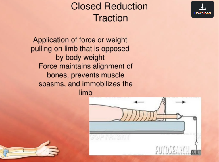 <p><span>closed reduction </span></p>