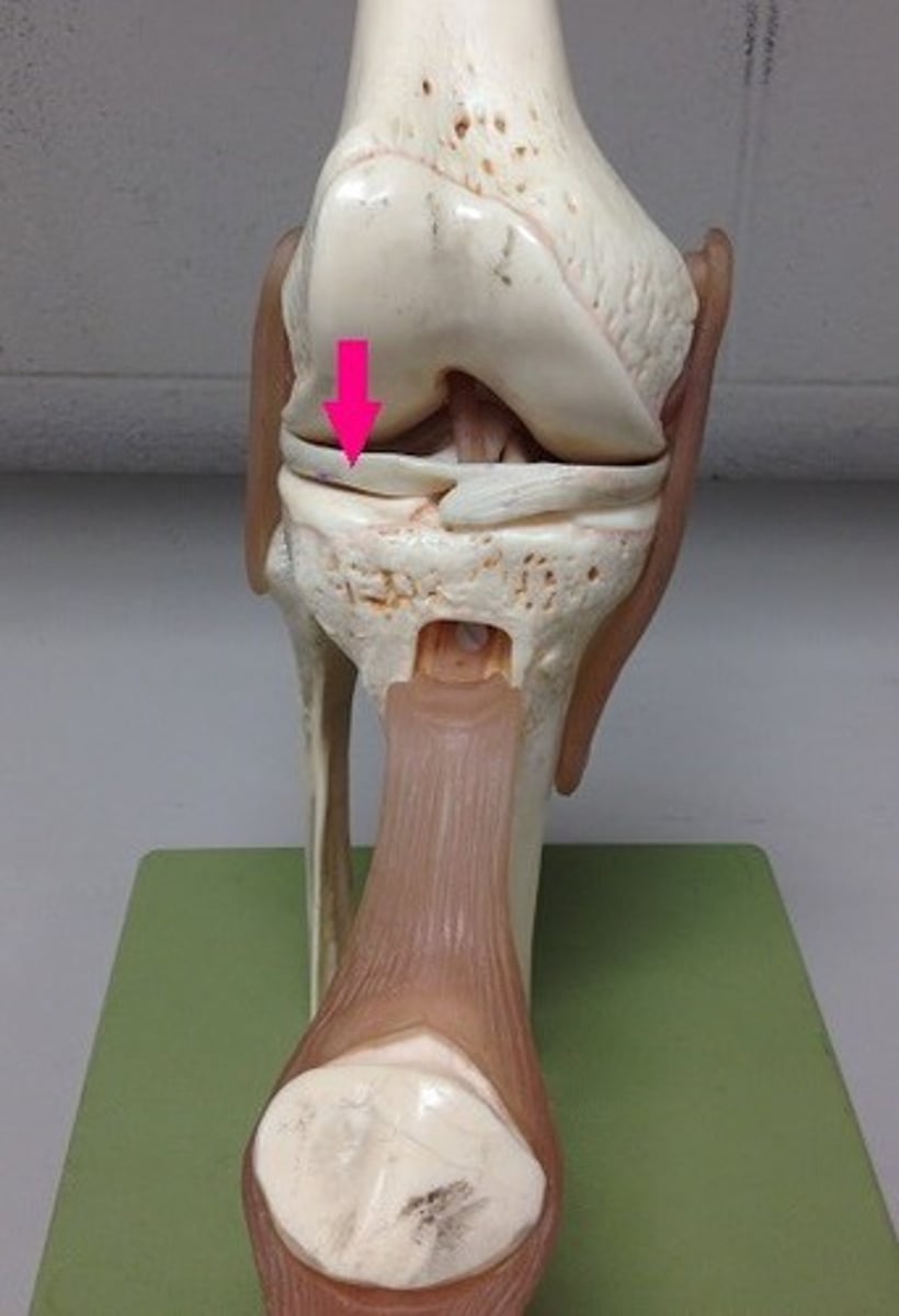 <p>cartilage in the knee between the lateral femoral condyle and the lateral tibial plateau</p>