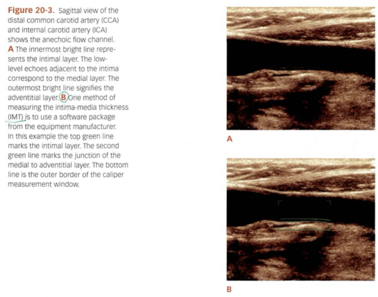 <p>Intima media thickness. Predictor for cardiovascular disease. Greater than 0.9mm = Intimal thickening.</p>
