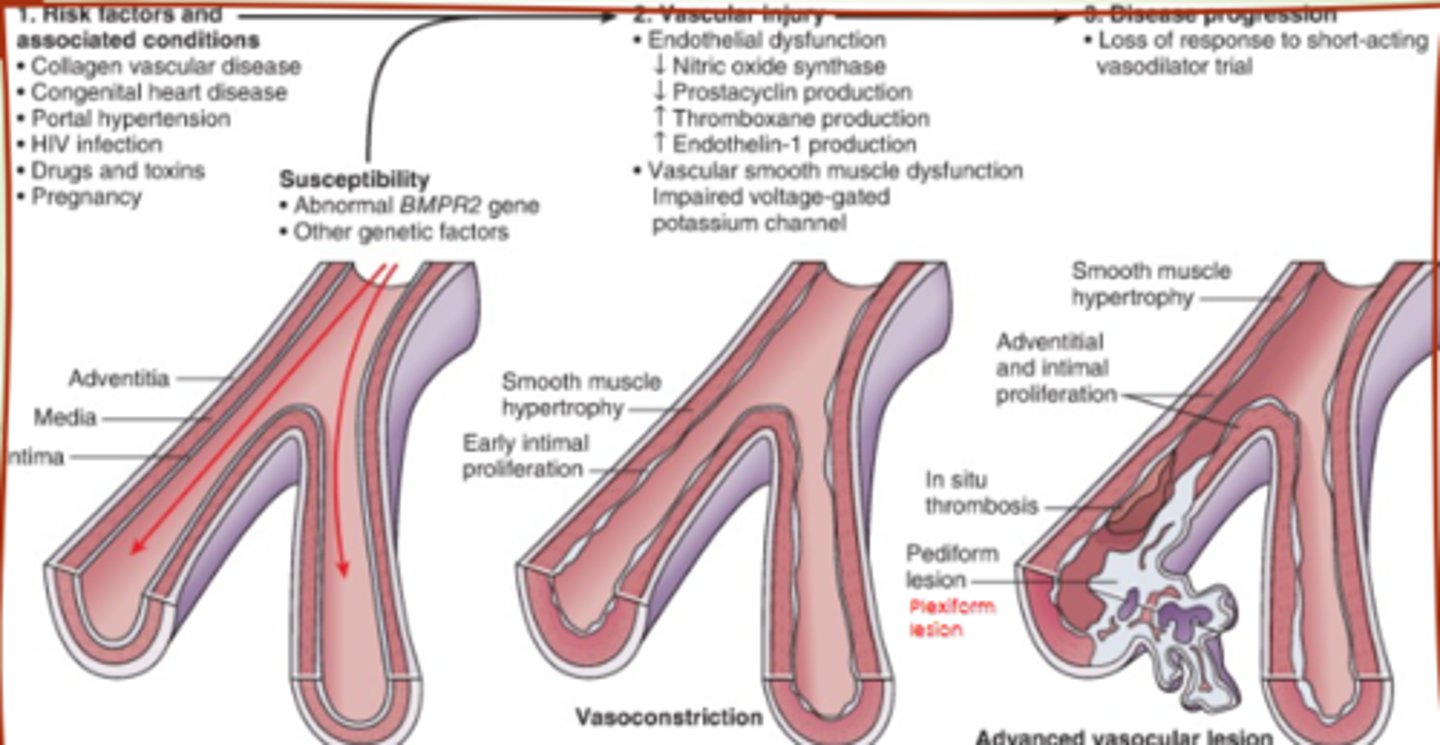 <p>- hypertrophy of smooth muscle (grow too much)</p><p>- endothelial dysfunction (lining can't relax)</p><p>- adventitial proliferation (outer layers grow too much)</p><p>- thrombosis and lesions (clots and scars)</p>