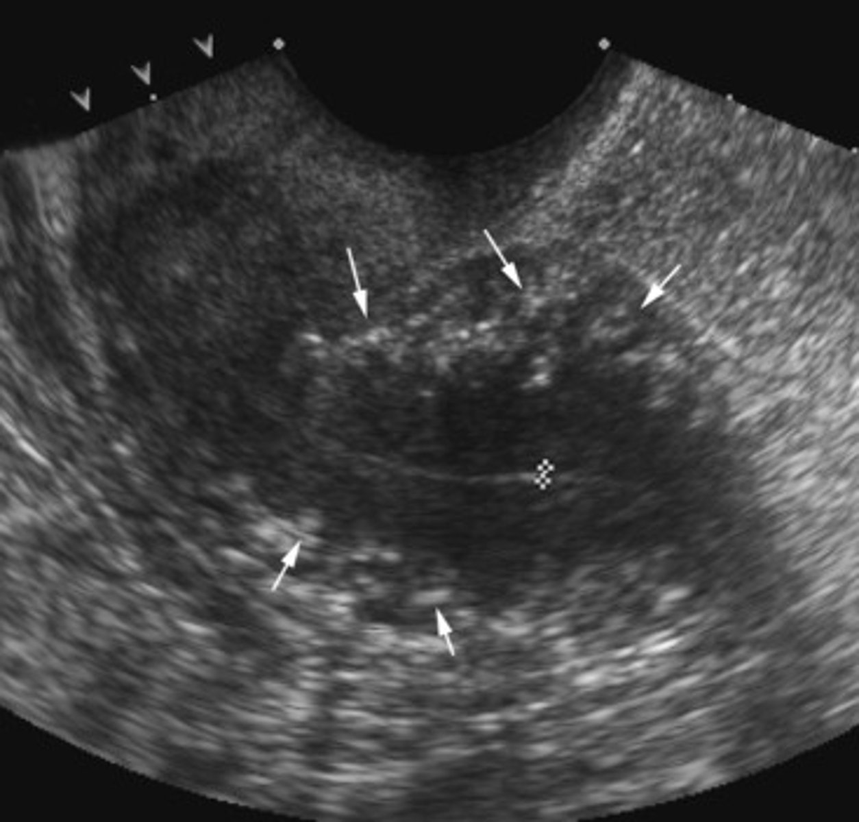 <p>tiny mineral deposits within the breast tissue, they appear as white spots on the image, they may or may not be cancerous</p>