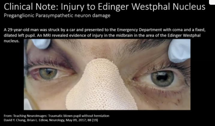 <p>-Edinger Westphal nucleus is located in the midbrain, part of the brainstem</p><p>*in this example the pupil is dilated due to the unopposed action of the sympathetics that innervate the dilator pupillae muscle</p>