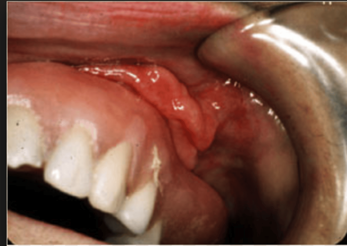<p>AKA Inflammatory Fibrous Hyperplasia </p><p>• elongated folds of firm tissue with central crater </p><p>• may be ulcerated</p><p>• associated with CD (denture)</p><p>• common location: vestibule</p>