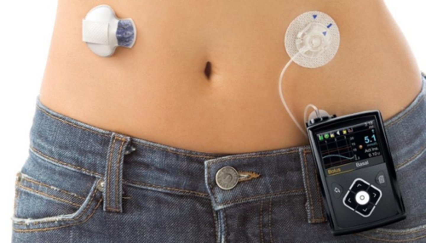 <p>A CGM, an insulin pump, and an algorithm that automatically adjusts basal insulin.</p>