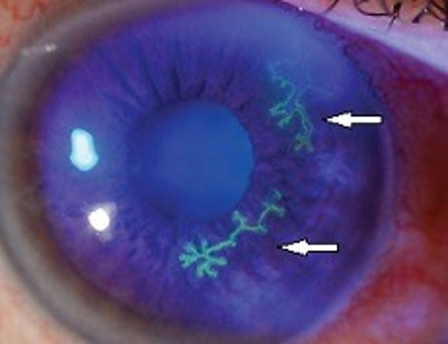 <p>Epithelial herpes keratitis is characterized by the presence of dendritic lesions</p>