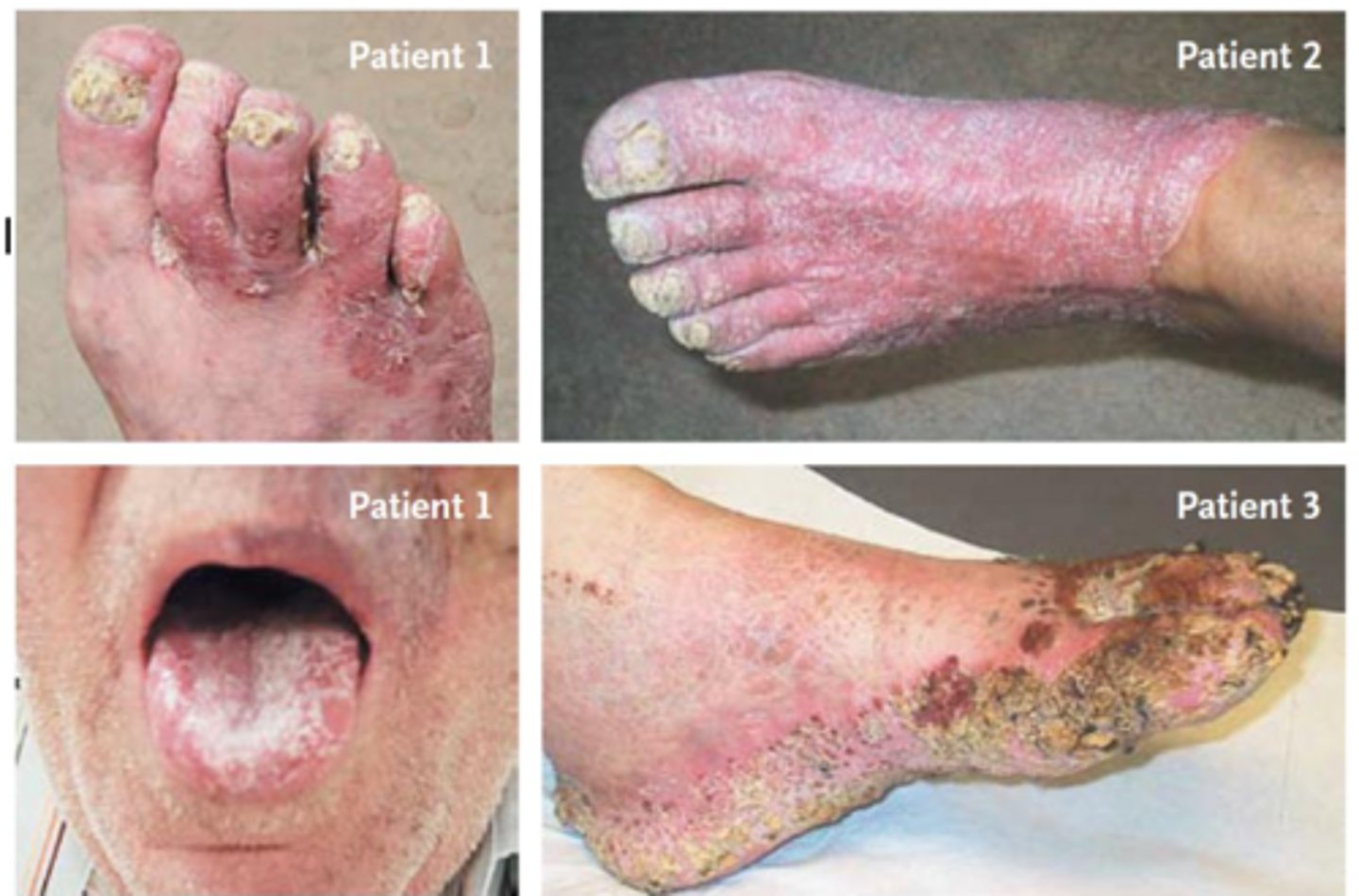 <p>ID the condition:</p><p>- A rapidly progressive, angioinvasive fungal infection.</p><p>- Clinical Presentations of rhino-orbital-cerebral mucormycosis include: facial pain, periorbital edema, black eschar, cranial nerve palsies</p>