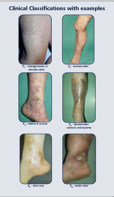 <p>What is the Clinical C classification ( for venous insufficiency) CEAP Classification ( only C category) </p>