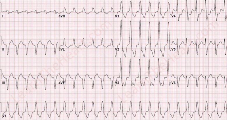 <p>What does this refer to “rapid, wide QRS complexes”</p>