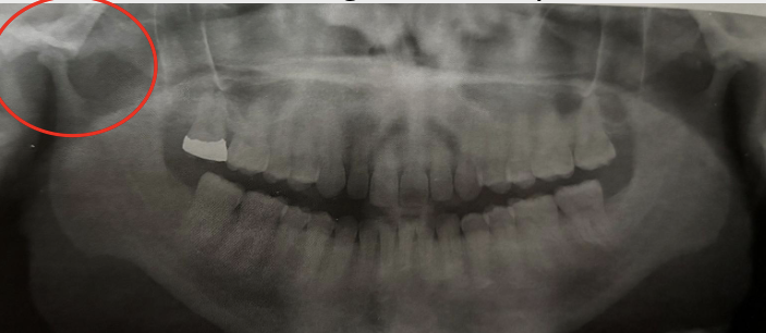 <p><span style="color: #000000">Underdeveloped condyle due to congenital or acquired</span></p>