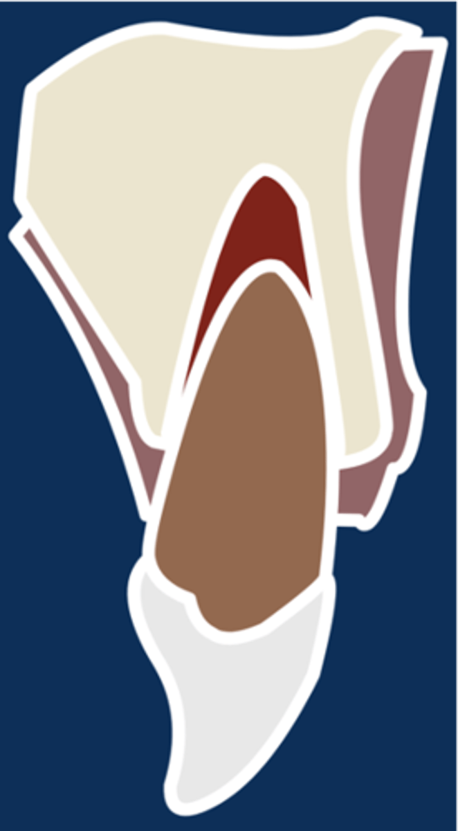 <p>Definition:</p><p>•Elongated, mobile tooth</p><p>•Partial displacement of the tooth out of socket.</p><p>•Angulated radiograph: increased PDL space apically</p><p>Treatment:</p><p>•Reposition</p><p>•Stabilize tooth with flexible splint for 1-2 weeks</p><p>•if pulp necrosis for complete root formation-&gt; endo</p>