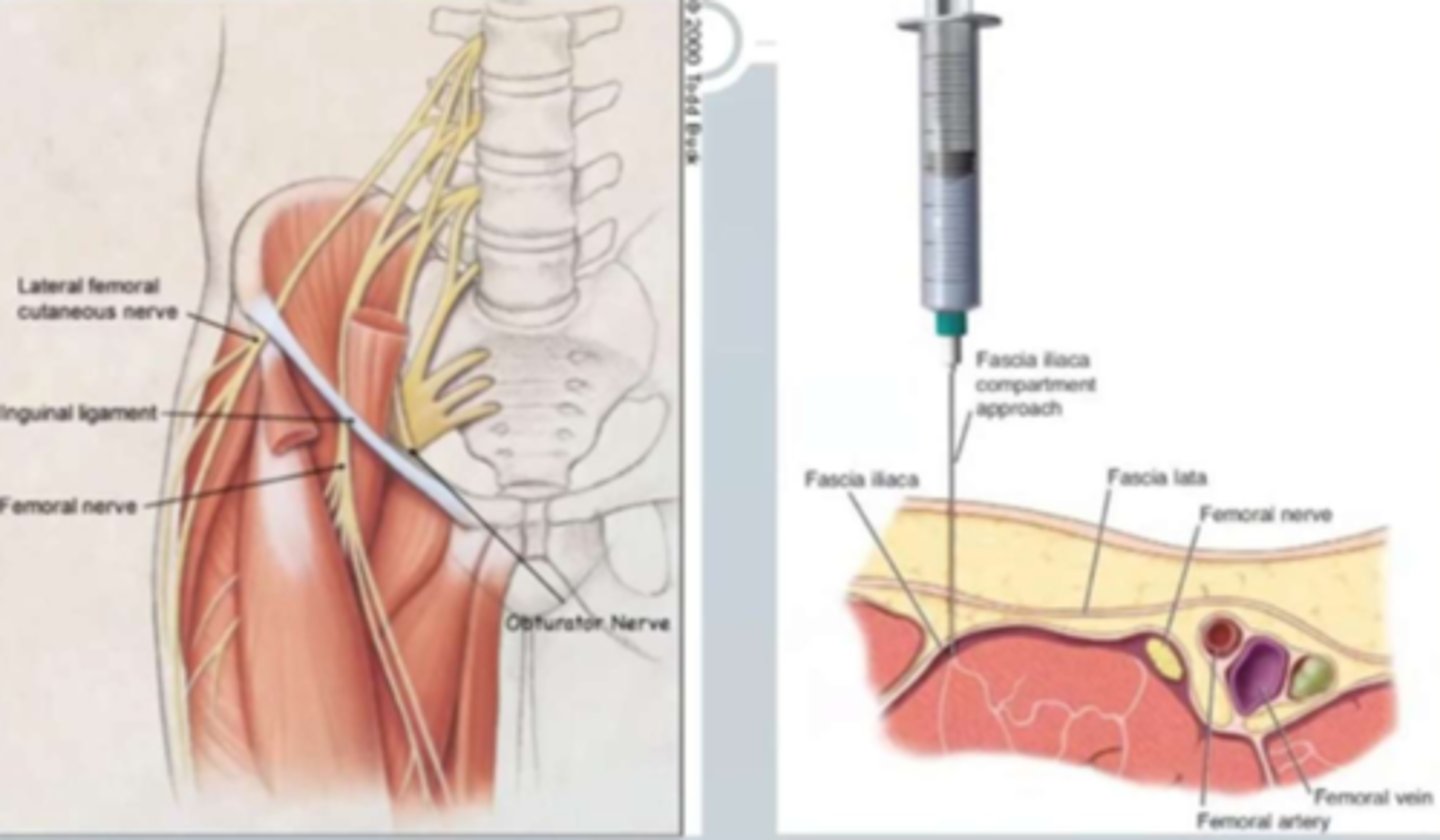 <p>- analgesics (opioids, Tylenol or synergy)</p><p>- NSAIDs</p><p>- anesthesia: local (nerve block under ultrasound guidance => eg. hip fractures, or spinal) or general</p><p>(note: nerve block for elderly hip fracture good bc they're at risk for opioid toxicity)</p>