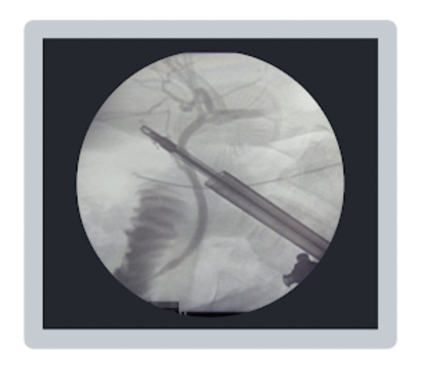 <p>Which mobile fluoroscopy procedure was taking place when the following image was taken? </p><p>a. retrograde urethrogram </p><p>b. upper gastrointestinal (GI) study </p><p>c. intraoperative cholangiogram </p><p>d. barium enema</p>