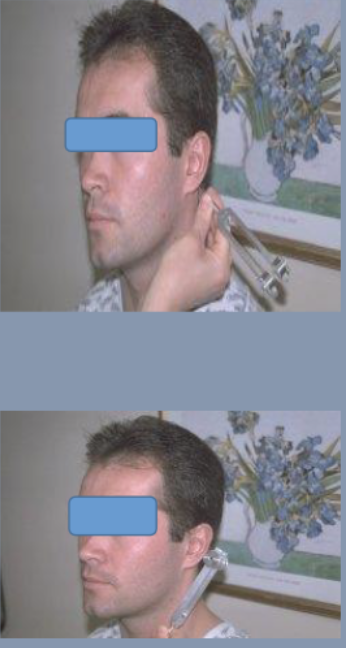 <p>compares air conduction to bone conduction</p><ol><li><p>wrap tuning fork firmly on palm and place butt on mastoid eminence firmly</p></li><li><p>ask patient to say “now” when they can no longer hear the vibration</p></li><li><p>when patient says “now”, remove butt from mastoid process and place U of tuning fork near the ear without touching it</p></li></ol><p></p>