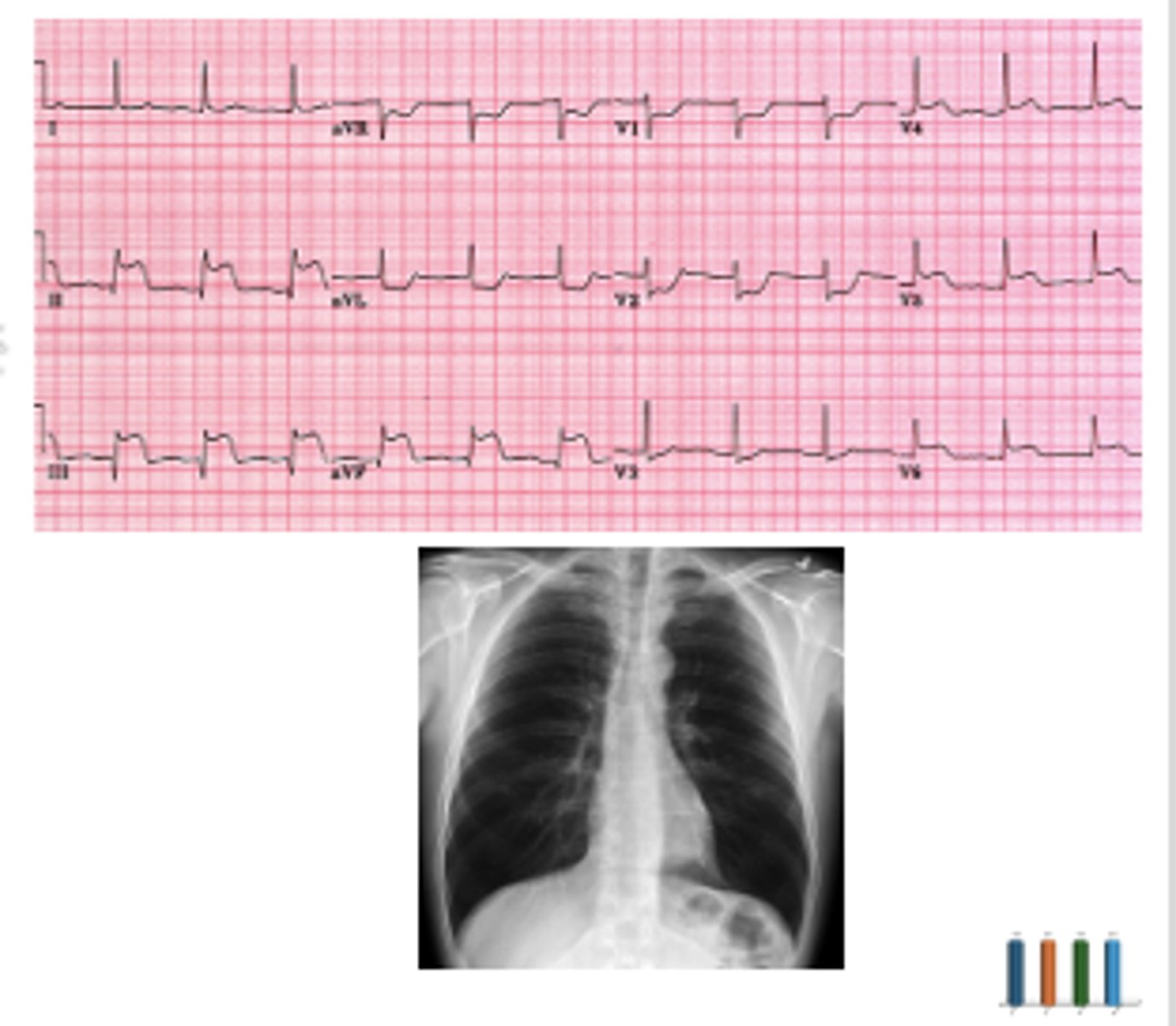 <p>A 73-year-old male with a past medical history of hyperlipidemia and tobacco use disorder presents to the emergency department with chest pain. His symptoms began 4 hours ago when he was returning up his driveway from getting the mail. He reports the pain feels like "crushing" in his chest and radiates into his jaw. You note that the patient is diaphoretic but otherwise exam is normal. High-sensitivity troponin 60 ng/L (normal &lt;10 ng/L). BNP is 300 pg/mL (normal &lt;100 pg/mL). ECG and chest xray as below. Which of the following is true?</p><p>A.The patient needs diuresis to offload excess volume from his heart</p><p>B.The patient needs cardiac cath lab AND diuresis</p><p>C.The patient needs cardiac cath lab without diuresis</p><p>D.The patient can be safely discharged home</p>