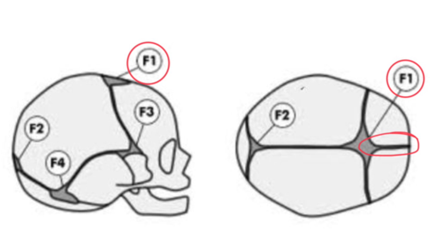 <p>What is the F1 suture in adults?<br>what can it increase risk of?</p>
