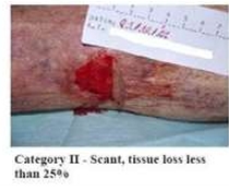 <p>Skin Tears: Category II</p>