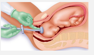 <p><strong>Vacuum Assisted Vaginal Delivery</strong></p><p>-Vacuum consists of vacuum cup placed on fetal _____ and a ________ device that is connected to the cup</p><p>-Exertion on the cup and consequently on the fetal scalp is made parallel to the axis of the maternal ______ along with maternal pushing and uterine ___________</p>