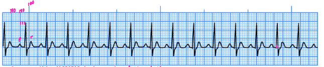 <p><strong>Sinus Tachycardia</strong></p><p>-Rhythm, intervals, and morphology are ______</p><p>-Rate is greater than ___ bpm</p><p>-P and T wave must be __________ to be considered sinus tachy</p>