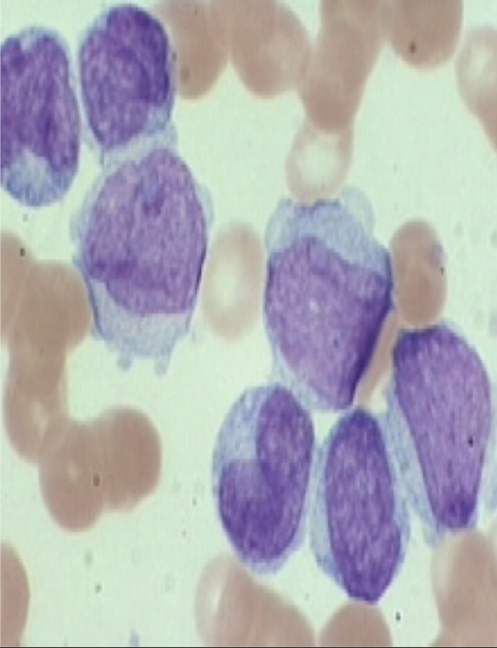 <p>What type of leukemia is this? Acute or Chronic</p>