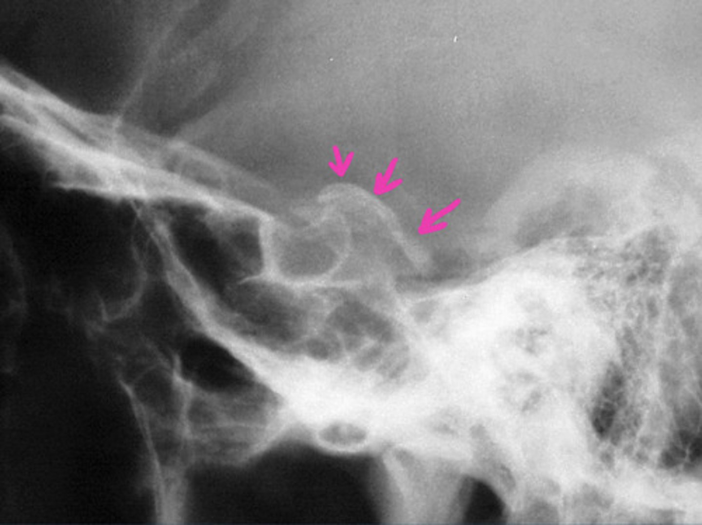 <p>Physiological calcification of the dura</p><p>No clinical significance</p>