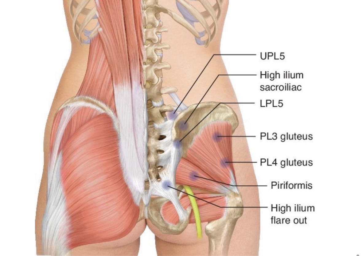 <p>we just need to know UPL5 and Piriformis</p>