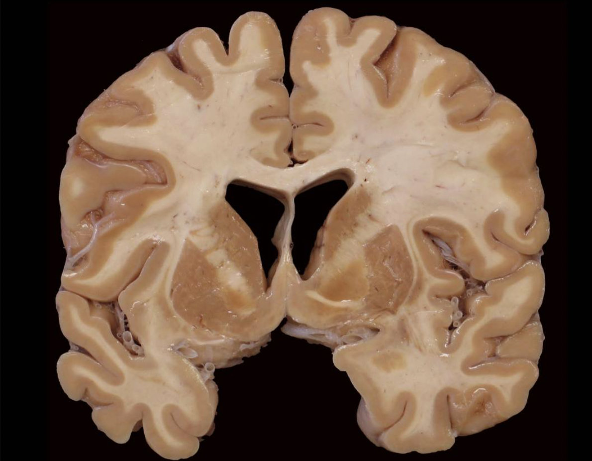 Inspect this photograph below and take a moment to orient yourself to the plane of section and the approximate position of this slab in the brain. Got it?

Given where you think this slab came from in the brain, which of the following gyri or lobules are visible in this slab?
 A. precuneus gyrus
 B. inferior parietal lobule
 C. superior parietal lobule
 D. superior frontal gyrus
 E. paracentral lobule