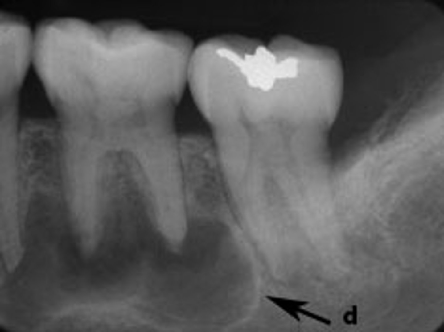 <p>Terms used to describe a MIXTURE of LIGHT &amp; DARK areas within a LESION, usually DENOTING a STAGE in PERIAPICAL CEMENTO-OSSEOUS DYSPLASIA (CEMENTOMA) (Fig. 1.9A), the LESION is RADIOLUCENT; in STAGE II it is RADIOLUCENT &amp; RADIOPAQUE (Fig. 1.9B).</p>