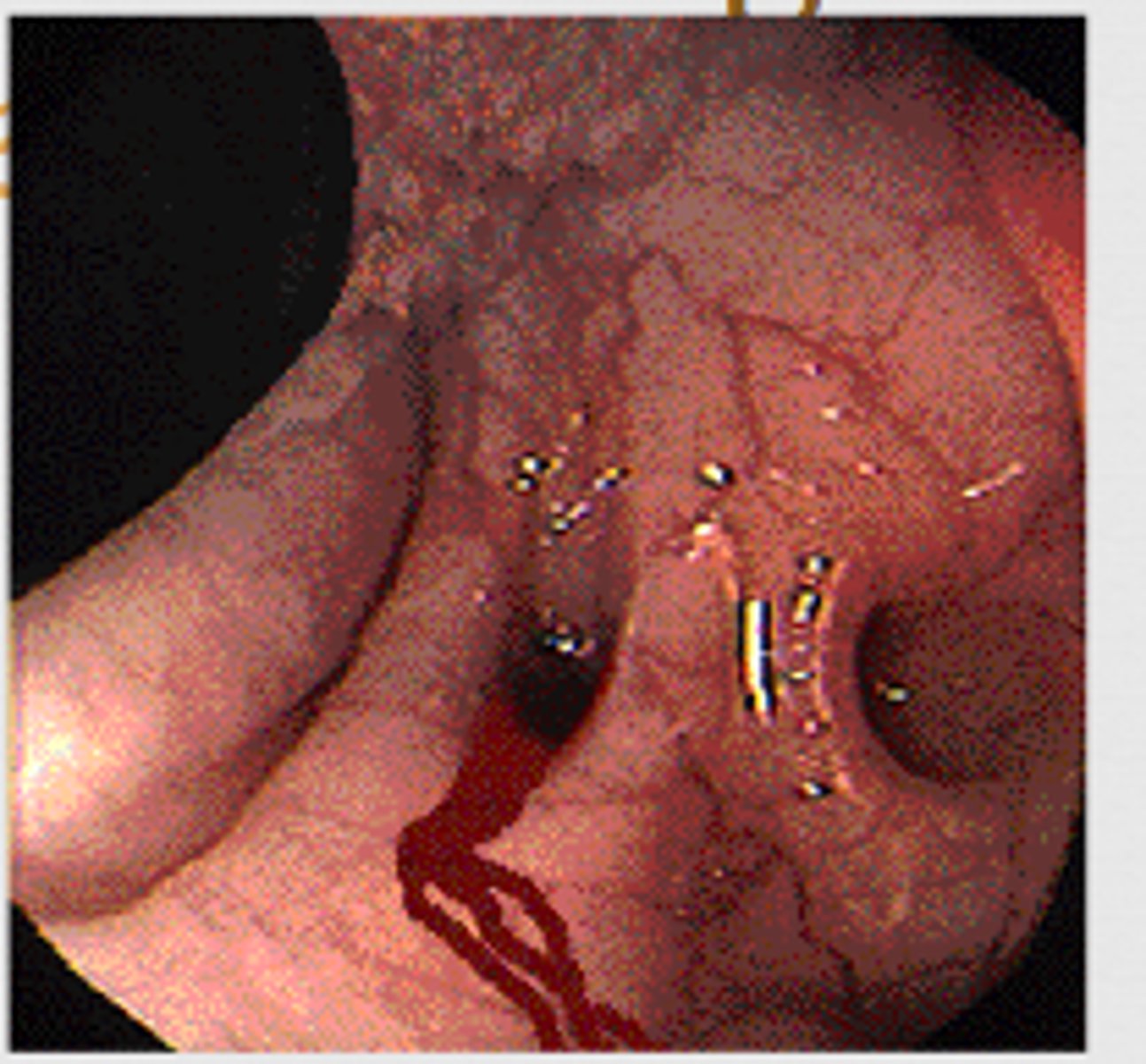 <p>-fluid resuscitation</p><p>-colonoscopy with endoscopic therapy</p><p>-CT angiogram with arterial embolization</p><p>-nuclear tagged red cell scan</p><p>-surgical: segmental resection, subtotal colectomy</p>