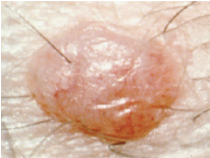<p><span>An elevated, solid lesion &lt;1 cm in size</span></p>
