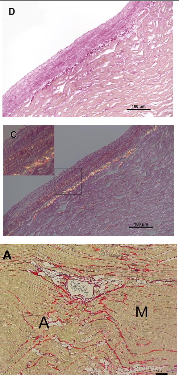 <p><span>Collagen fibers stain dark red in normal light and myocardium is stained a shade of yellow. If using polarized light collagen bundles are birefringent.</span></p><p></p><p><span>Upper Image: Normal light, collagen fibers stain red.</span></p><p><span>Middle Image: Polarized light, collagen bundles are birefringent.</span></p><p><span>Bottom Image: Dog with lone AF. Mild interstitial fibrosis (stained red) and mild adipocyte infiltration in the myocardium. Often this stain will stain myocardium yellow as seen in this example.</span></p>