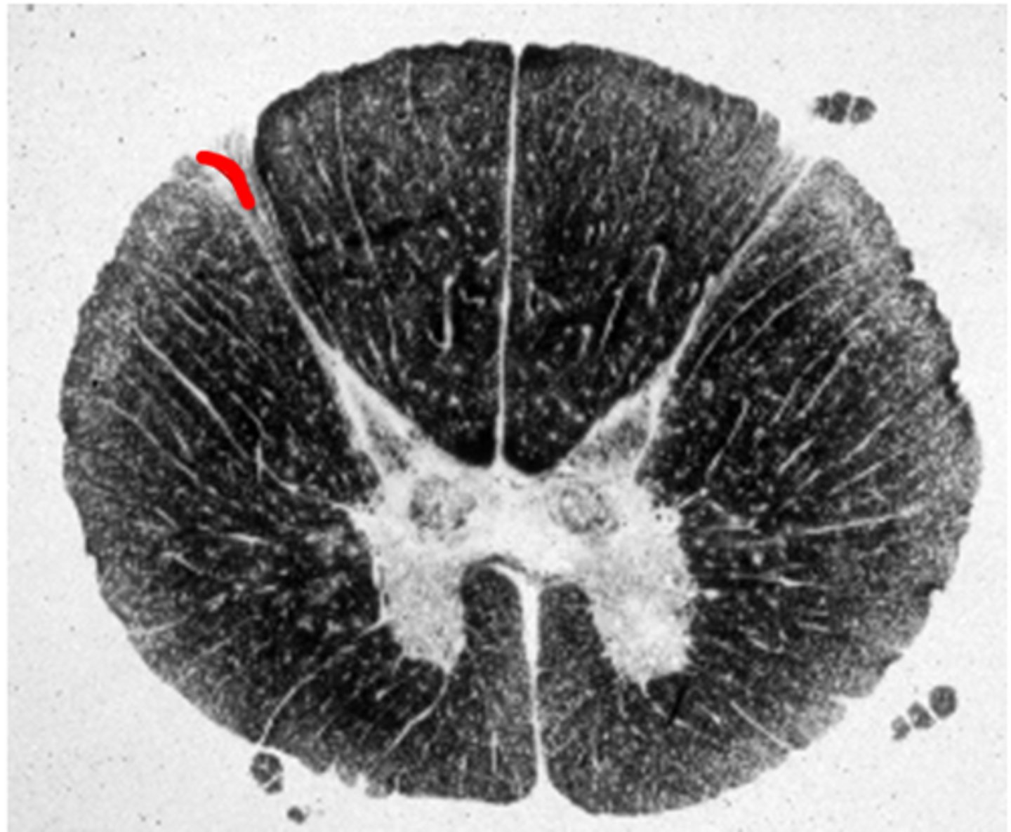 <p>Entry zone for the dorsal roots</p>