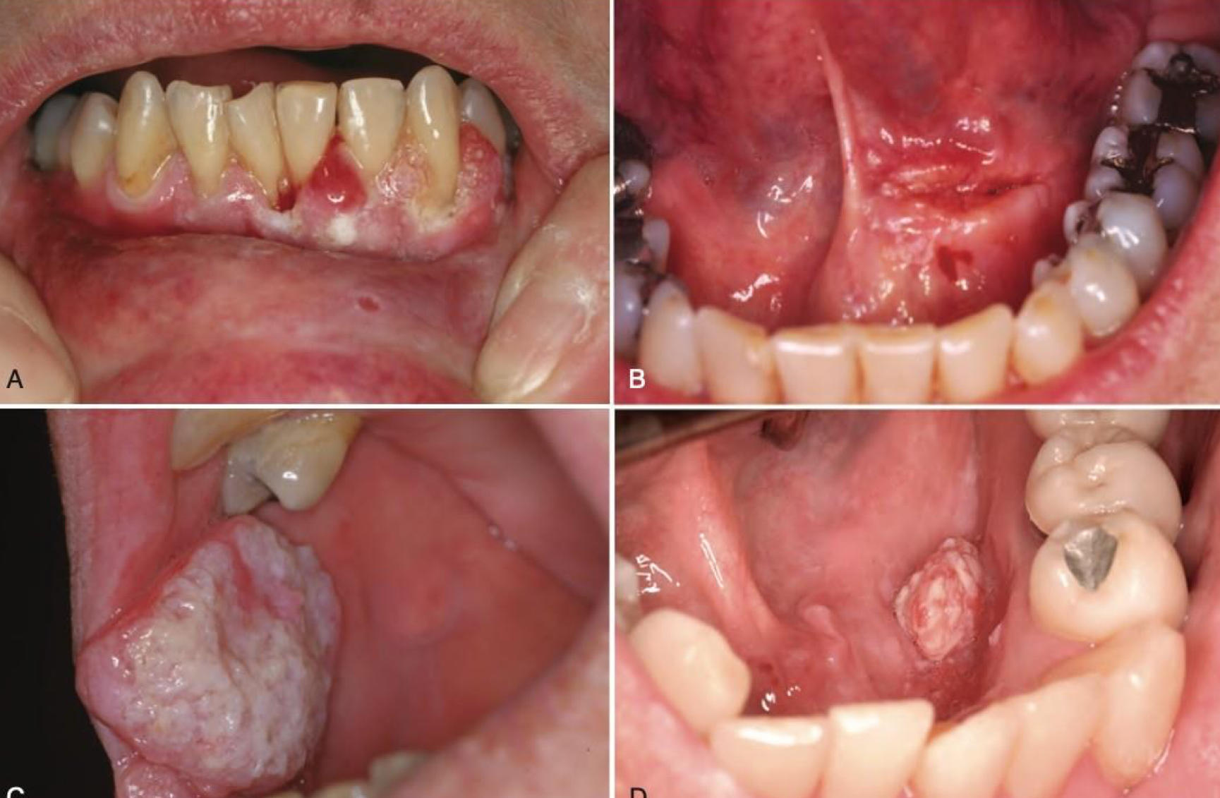 <p>which neoplastic white lesion:</p>