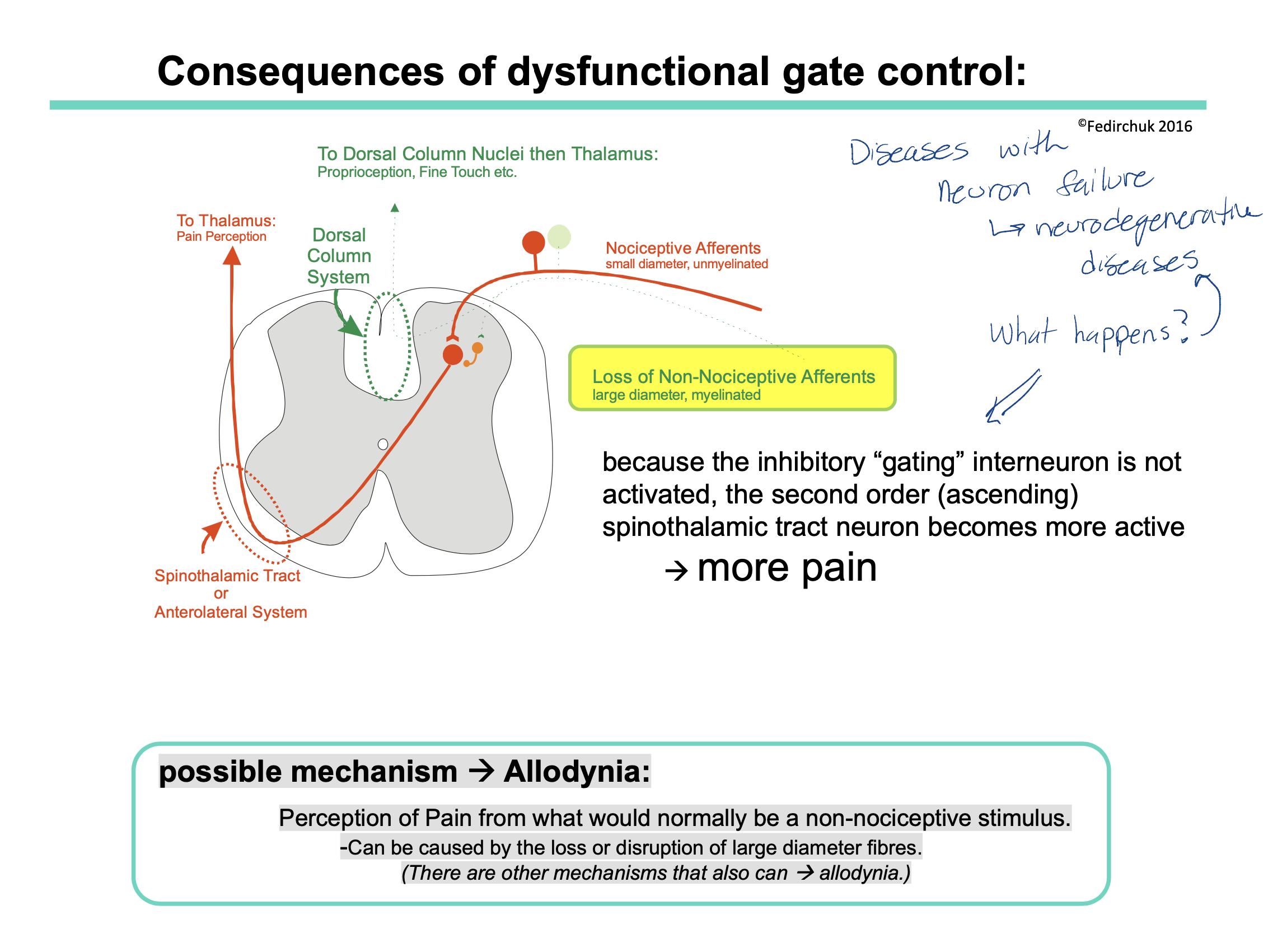 <p>If someone has a neurodegenerative disease, this could cause loss of certain neurons. This could be a problem if the neuron lost is the non-nociceptive neuron pathway. </p><p></p><p>Recall: the non-nociceptive neuron pathway sends mechanical signals to the brain via the dorsal column BUT also has the interneurons that inhibit the spinothalamic pathway (ie our pain pathway) </p><p></p><p>therefore if someone does not have the non-nocicpetive neuron pathway = less interneurons = less inhibition of the spinothalamic tract = more pain felt </p><p></p><p><u>possible mechanism = allodynia </u></p><ul><li><p>allodynia = <span>is a condition where a person perceives pain in response to a stimulus that is not typically painful</span></p></li><li><p>When non-nociceptive (aka large diameter fibers) are compromised, the normal inhibitory signals that prevent the perception of pain from non-nociceptive stimuli may be reduced.</p></li><li><p>As a result, stimuli that would typically be interpreted by the nervous system as non-painful (such as light touch or temperature changes) are now processed as painful signals.</p></li></ul>