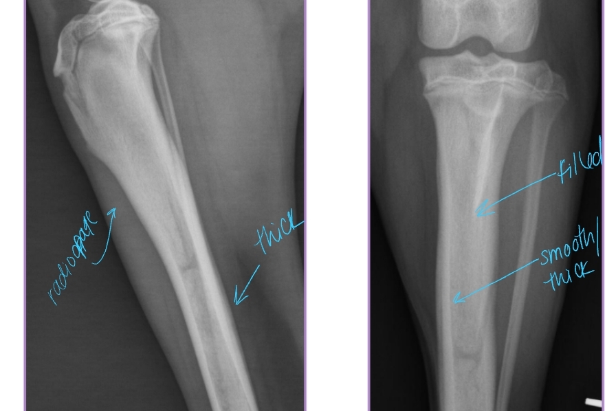 <ul><li><p><span style="background-color: transparent;"><strong><span>Et: </span></strong></span><span style="background-color: transparent; color: red;"><strong><span>Disease of endosteum and bone marrow</span></strong></span><span style="background-color: transparent;"><span> in the </span></span><span style="background-color: transparent; color: red;"><strong><span>long bones</span></strong></span></p><ul><li><p><span style="background-color: transparent;"><u><span>Increased IO pressure</span></u><span> due to protein </span><u><span>accumulation near nutrient foramen (near major BV)</span></u><span>, medullary vessels leakage</span></span></p></li><li><p><span style="background-color: transparent;"><strong><span>ulna, humerus, radius, femur, tibia</span></strong></span></p></li><li><p><span style="background-color: transparent;"><span>Forelimb > hindlimb</span></span></p></li></ul></li></ul><ul><li><p><span style="background-color: transparent;"><strong><span>Sig: </span></strong></span><span style="background-color: transparent; color: red;"><strong><span>5-18 months, male </span></strong><span>> female</span><strong><span>, large breed</span></strong></span></p></li></ul><ul><li><p><span style="background-color: transparent; color: rgb(9, 9, 9);"><strong><span>Cs:</span></strong></span><span style="background-color: transparent; color: red;"><strong><span> Shifting leg lameness, Lethargic, Pain (cyclic), Anorexia, Fever</span></strong></span></p></li></ul><ul><li><p><span style="background-color: transparent;"><strong><span>Dt: </span></strong></span></p><ul><li><p><span style="background-color: transparent;"><strong><span>PE: pain on palpation</span></strong><span> of </span><strong><span>diaphysis</span></strong><span> of long bone</span></span></p><ul><li><p>pain receptors in periosteum</p></li></ul></li><li><p><span style="background-color: transparent;"><strong><span>Radiographs: </span></strong></span><span style="background-color: transparent; color: red;"><span>Radiodense, patchy infiltrates,</span></span><span style="background-color: transparent;"><span> Widening of nutrient foramen</span></span></p><ul><li><p><span style="background-color: transparent;"><strong><span>Late</span></strong><span> periosteal response – </span></span><span style="background-color: transparent; color: red;"><span>smooth, thick cortex</span></span><span style="background-color: transparent;"><span> appearance</span></span></p></li></ul></li></ul></li><li><p><span style="background-color: transparent;"><strong><span>Tx:</span></strong><span> Analgesics, </span><strong><span>Res</span></strong><span>t, </span><strong><u><span>Self-limiting</span></u></strong><span> </span><strong><span>(1-2w)</span></strong></span></p></li><li><p><span style="background-color: transparent;"><span>relapse can present in other bones</span></span></p></li></ul><p></p>