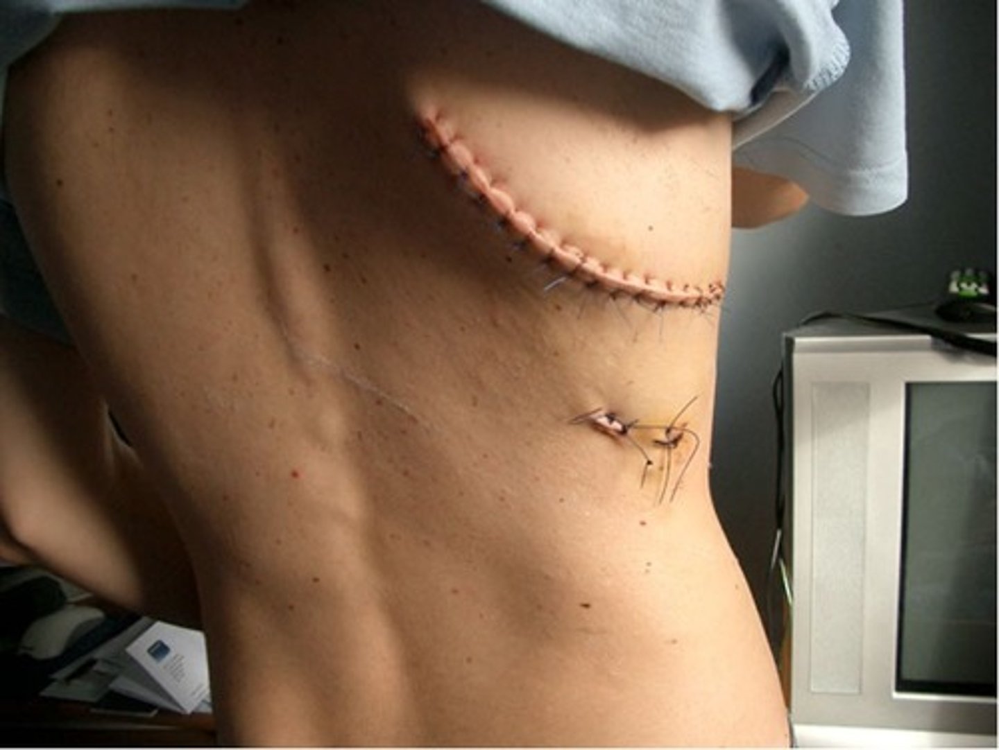 <p>usually through 4th-5th ICS</p><p>May be anterior or posterior lateral incisions</p><p>Very painful</p><p>May be performed with muscle sparing</p><p>Muscle retraction, not muscle transection</p>