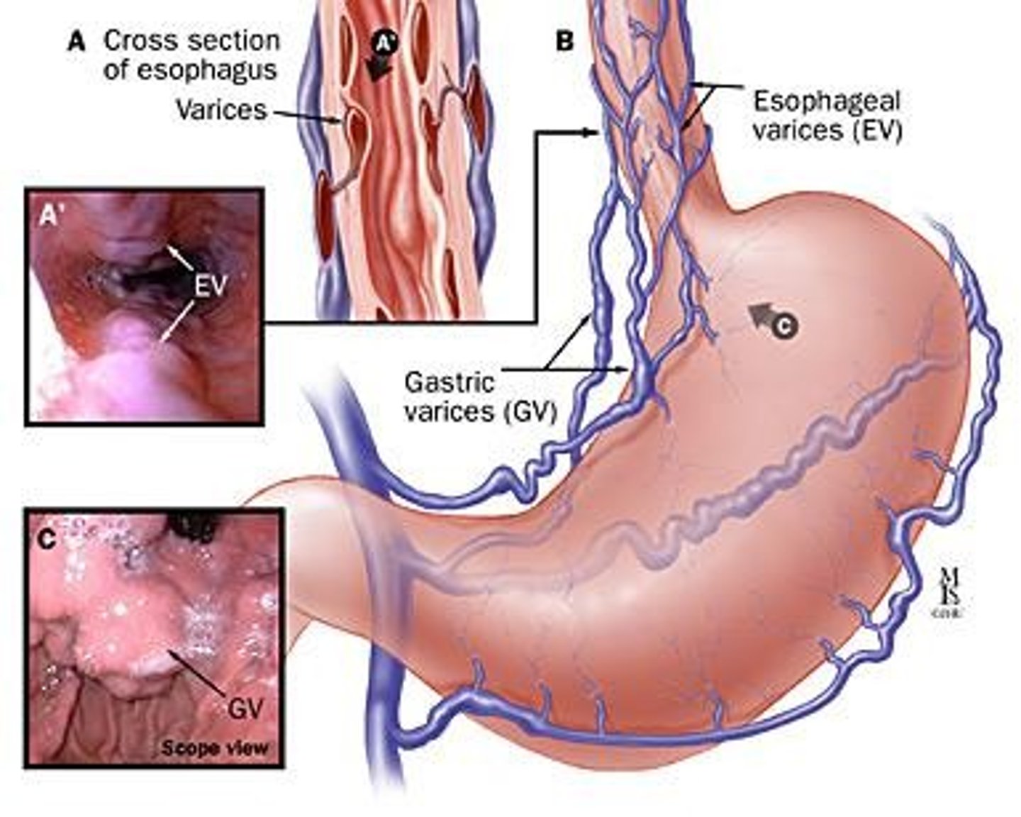 <p>Distended veins in esophagus due to portal hypertension.</p>