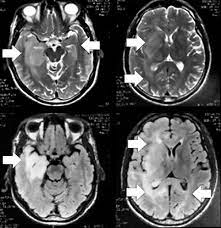 <p>Hipersinal em T2/FLAIR no lobo temporal medial bilateral + hipocampo → áreas multifocais corticais/substância branca → desmielinização/inflamação</p>