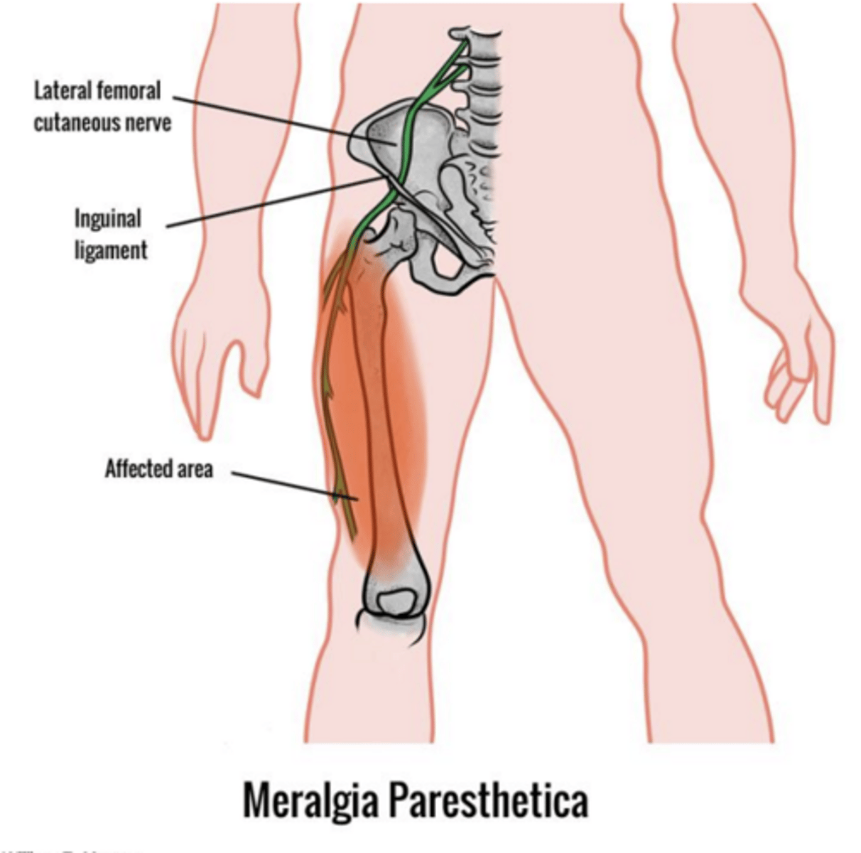<p>Paresthesias, numbness, or pain in the lateral thigh worse with standing typically without motor weakness</p>