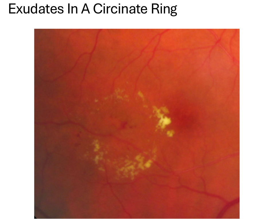 <p><strong>circinate rings </strong>with edema/fluid found in middle of the ring</p>