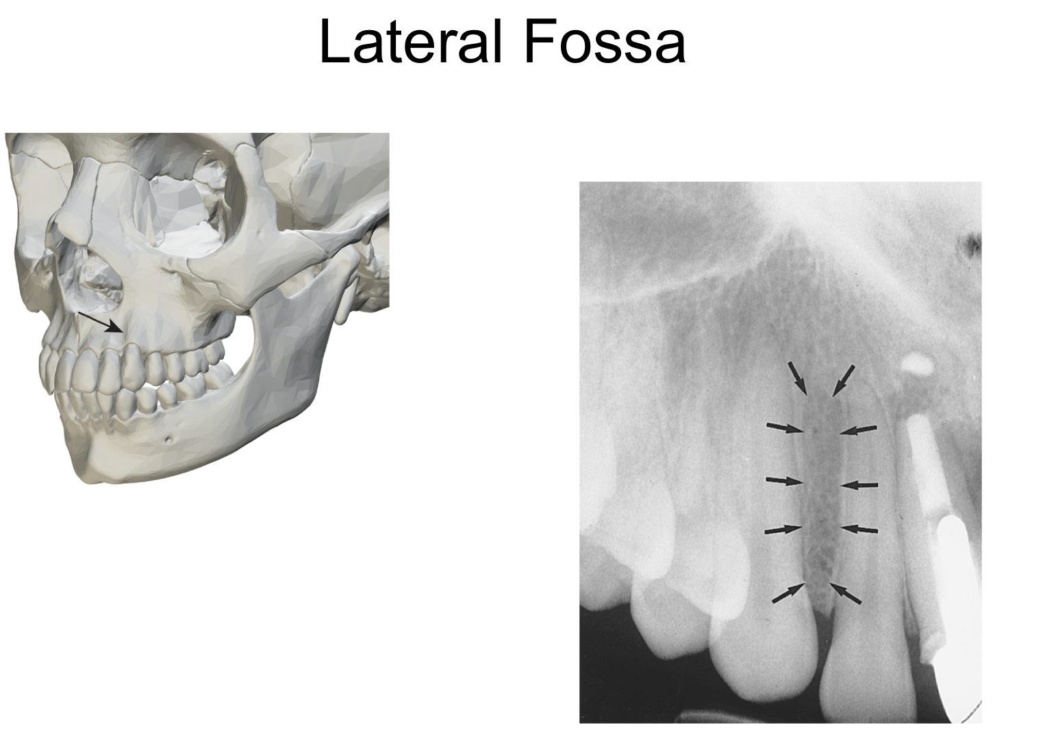 * smooth depressed area of maxilla
* aka canine fossa
* radiolucent
